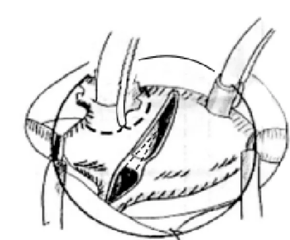 Fig. 3 - Diagram of the purse-string sutures at the right appendage base and of the biatrial incision to section the interatrial septum (modified by Dubost et al [13])