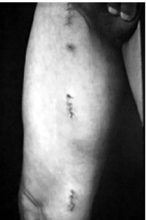 Fig. 2 -  Final aspect on the seventh postoperative day