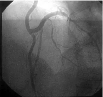 Fig. 2 - Angiographic study of the compound graft with the left internal thoracic artery grafted to the anterior interventricular artery and a segment of the great saphenous vein grafted to a circumflex marginal artery