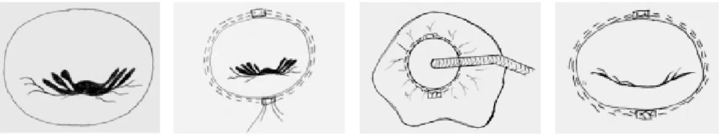Fig. 3 - Preoperative transesophageal echocardiogramTable 2.Procedures performed