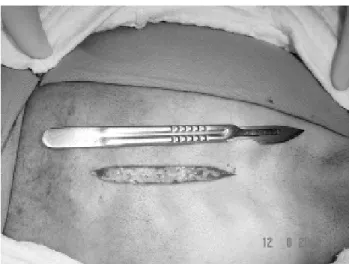 Fig. 1 - Photograph of the initial skin incision (patient 1).