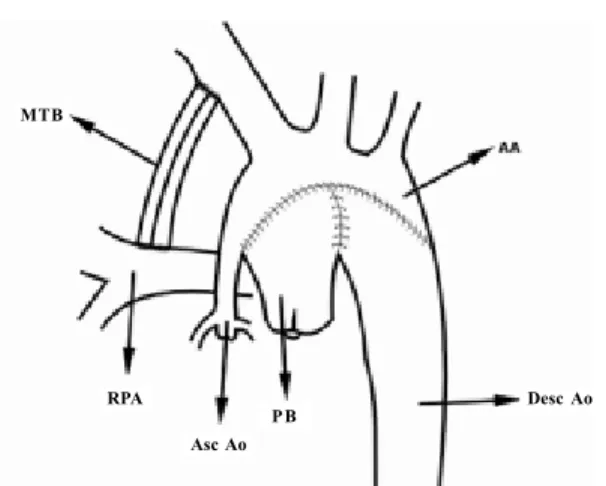 Fig. 1: Diagram of the surgical technique employed.