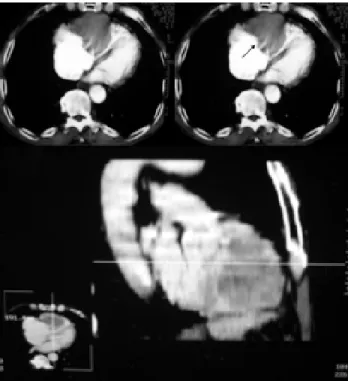 Fig. 5 - Computed chest tomography. Note the presence of an extensive injury – hypodense with well-defined limits involving the anterior wall of the heart (arrow).