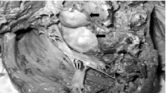 Fig. 8 - Malignant thymoma invading mediastinal structures and the heart. Note the presence of a tumoral mass (arrow) with a nacre-coloured aspect completely obliterating the tricuspid valve.