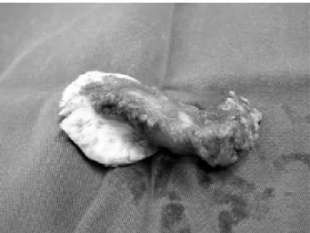 Fig. 2 - Resection of the floating pedunculated thrombus adhered to the wall of the ascending aorta