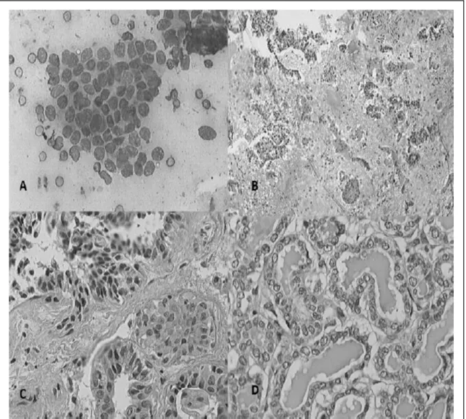 Figura  1–A:  Fotomicrograﬁ a  de  citologia  corada  pelo  método  Panótico  Rápido,  evidenciando-se  células  cubóides,  distribuídas  em  bloco  coeso  com  discreto  pleomorﬁ smo,  evidenciado por  anisocitose,  incremento  na  relação núcleo/citoplas