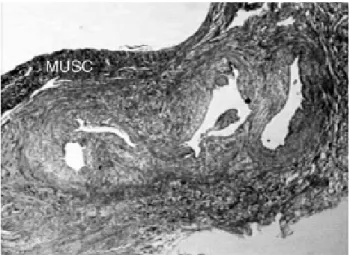 Fig. 3 - Crosswise histological section of the anterior descending coronary artery post-implantation of stent demonstrating intimal hyalinosis (a) and the muscle of the wall of the vessel (b)