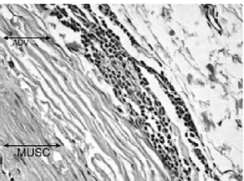 Fig. 6 - Cinecoronariography demonstrating normal LCT when a stent was implanted in the marginal branch of the circumflex artery.