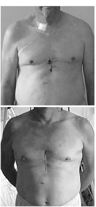 Fig. 3 - Final appearance of the cutaneous incision