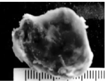 Fig. 1 - Hemodynamic study showing the hemangioma Fig. 2A - Hemangioma – macroscopic appearance