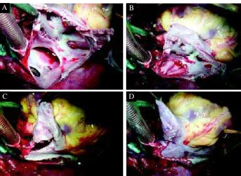 Fig. 2 -  A – right atrium open where the right pulmonary veins can be seen draining into the left atrium and the flow towards the superior sinus venosus interatrial communication