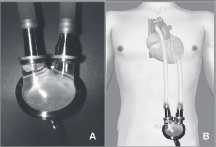 Fig. 1 – Photograph (A) and Diagram (B) of InCor paracorporeal ventricular assist device implanted as a circulatory assist device in parallel to right and left ventricles.