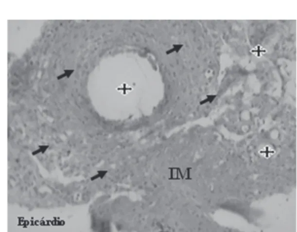 Fig. 6 - Neovessel (star), endothelial cells (arrows) and smooth muscle cells (double arrows), after the transplantation of mesenchymal cells in myocardial infarction (MI) – Gomori’s Trichrome, x 400