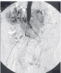 Fig. 1 - Horseshoe kidney with particular blood flow