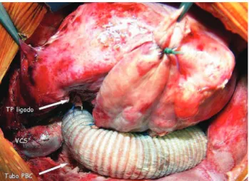 Fig. 2 – Tubo de pericárdio bovino corrugado (PBC) conectando a veia cava inferior à artéria pulmonar