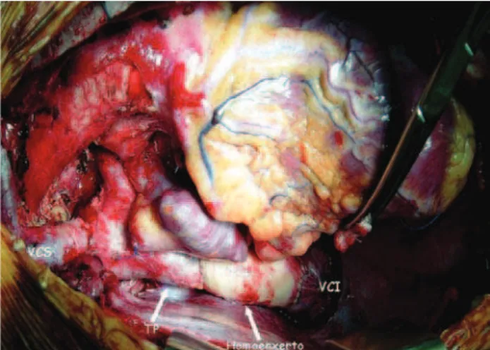 Fig. 3 - Homoenxerto criopreservado de aorta descendente como tubo extracardíaco conectando a veia cava inferior (VCI) ao tronco pulmonar (TP)