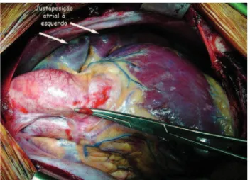 Fig. 2 - Juxtaposition of the left and right atrial appendixes to the left.