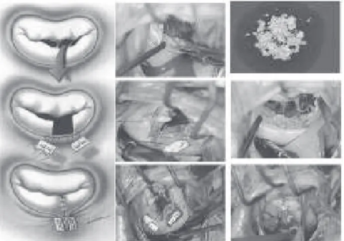 Fig. 2 - Pre and post-operative functional class (NYHA)