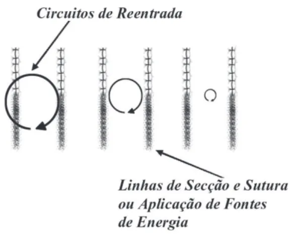 Fig. 2 - Esquema representando: as linhas de secção e sutura bloqueando os circuitos de reentrada responsáveis pela manutenção da fibrilação atrial