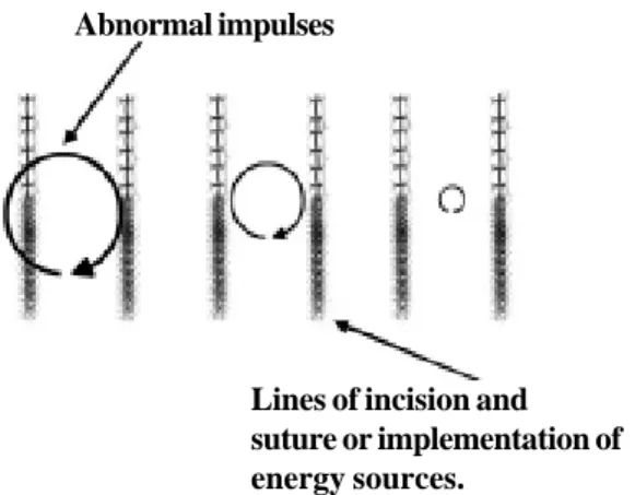 Figure 2 shows the electrophysiological bases of surgeries for the treatment of AF, with the obstruction of abnormal impulses by incisions and sutures or by ablation using energy sources.