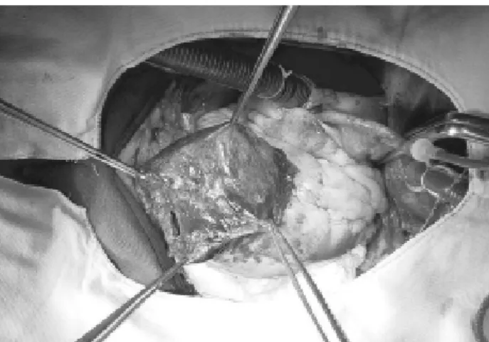 Fig. 1 - Aneurysm in anterior wall of the torn left ventricle