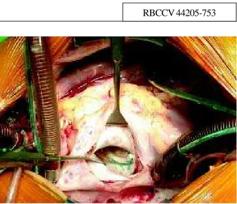 Fig. 1- Anel de Gregori utilizado na plastia da valva mitral visibilizado através de abertura longitudinal no septo interatrial