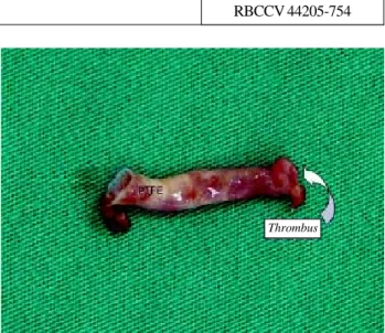 Fig. 1 – Polytetrafluoroethylene (PTFE) graft with typical thrombus of infectious endocarditis at the pulmonary artery end