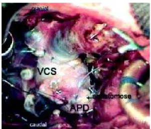 Fig. 1 - Operative field. Anastomosis of the superior vena cava in the right pulmonary artery