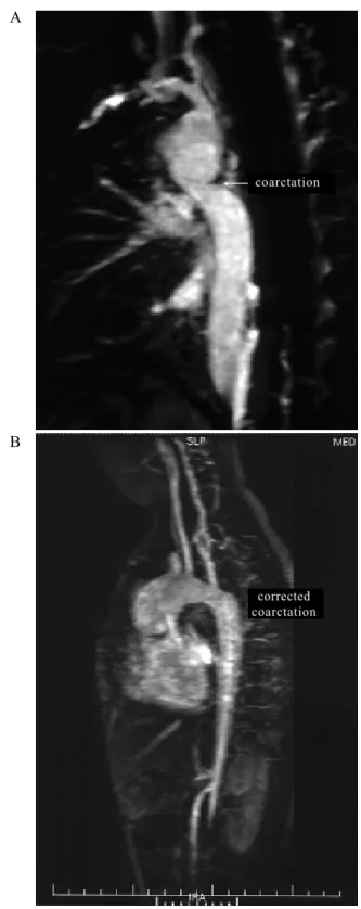 Fig. 2 - Chest angiorressonancia. A- Aortic coarction de aorta.