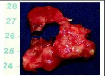 Fig. 2 - Thrombus removed from the pulmonary artery (scale in centimeters)
