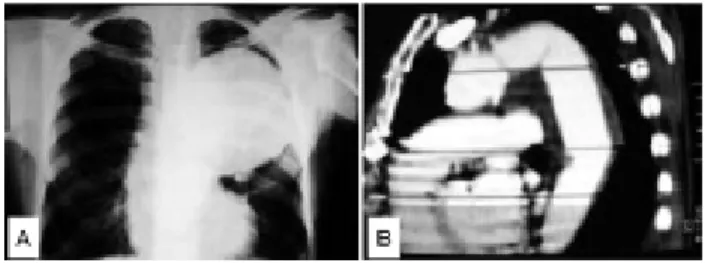 Fig. 2 - A- Chest radiography taken in the preoperative period that shows a large growth in the medial and upper mediastinum, invading the left hemithorax