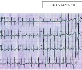 Fig. 1 – Electrocardiogram with characteristics of situs inversus and dextrocardia, obtained with the precordial derivations to the right and without inversion of the electrodes on the limbs