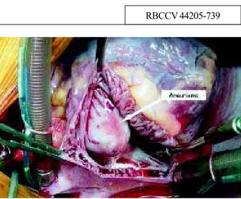 Fig. 1 – Aneurysmal bulging of the right coronary Valsalva sinus observed after opening the right atrium