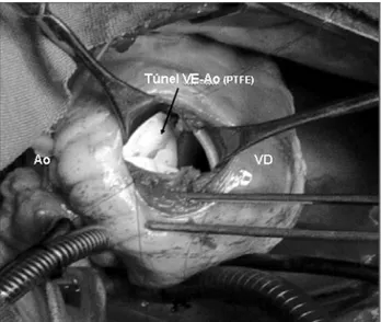 Fig. 3 – Surgery photograph – Aspect of the anterior face of the right ventricle (RV)