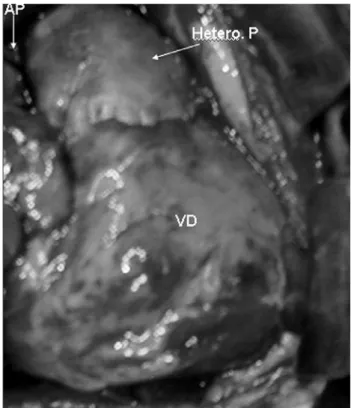 Fig. 7 – Surgery photograph – Reconstruction of the right ventricle junction (RV) – pulmonary artery (PA) with pulmonary heterograft (P Hetero.)