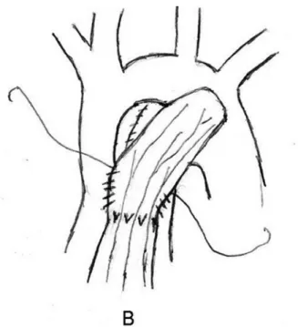 Fig. 4 - surgical implantation, using the same Norwood’s operation, of an autologous vascularized pericardial patch which grows as the patient gets older and taller