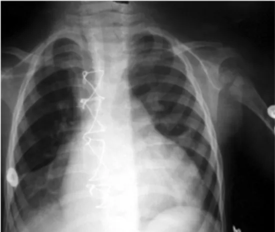 Fig. 2 - Chest radiogram in the posteroanterior position on the 16th postoperative day showing clear improvement of the right basal atelectasis