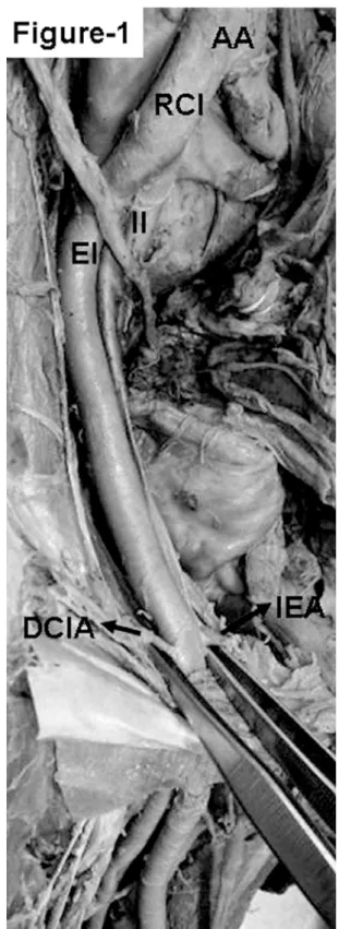 Fig. 1 - Photograph of the pelvic region. The abdominal aorta (AA) is seen dividing at a higher level, so also is the right common iliac artery (RCI)