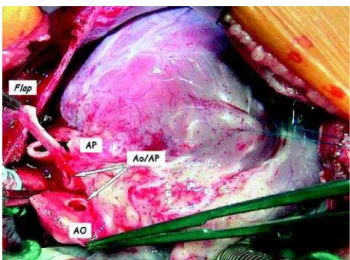 Fig. 2 - Inter-operative appearance with the flap of the pulmonary artery sectioned crosswise to create the tunnel