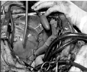 Fig. 3 - Picture of the artificial pulmonary ventricle (a). The pulmonary artery connection of the artificial pulmonary ventricle via an 8-mm Dacron graft (b).