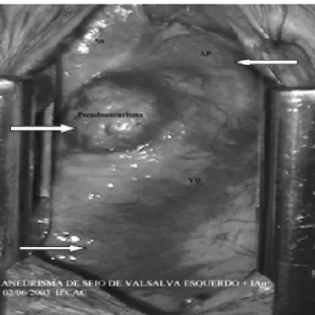 Fig. 2 - Open right ventricle showing the pseudoaneurysm with neck of around 2 cm. (left lower arrow)
