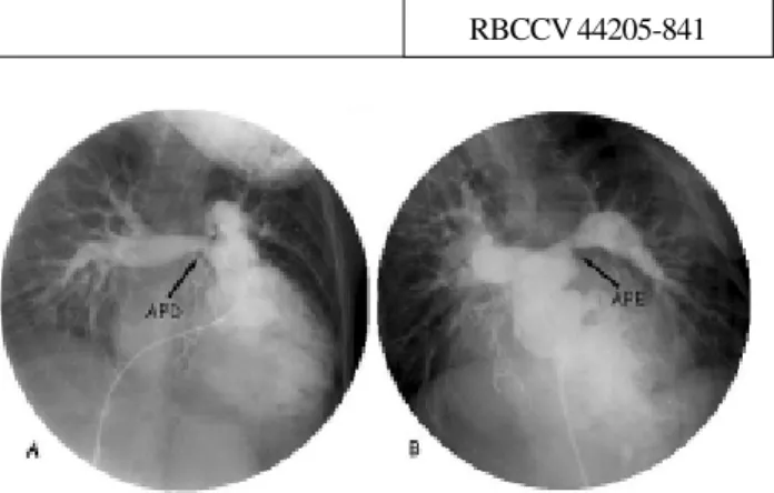 Fig. 1 – Estudo cineangiográfico. A: estenose na origem da artéria pulmonar direita (APD), B: estenose na origem da artéria pulmonar esquerda (APE)