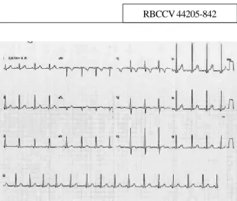 Fig. 1 - Pre-operative electrocardiogram without direct signs of left ventricular hypertrophy