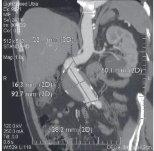 Fig. 1 – Some measurements in the computed tomography in the  preoperative evaluation of a patient with AAA and angled neck