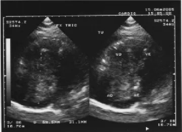 Fig. 1 – Transthoracic echocardiogram showing a mass of approximately 2.5 x 5.5 cm inside the right atrium
