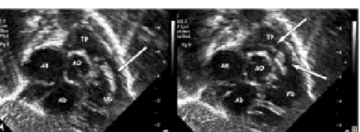 Fig. 1 - Coronal subcostal echocardiographic slices demonstrating: