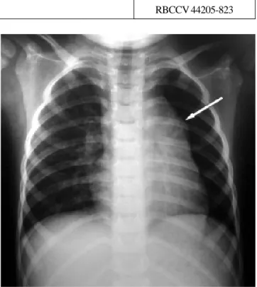 Fig. 1 – Postero-anterior chest radiogram with bulging of the middle arch (arrow)