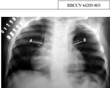 Fig. 1 – Radiograma de tórax. A: opacidade hilar superior à silhueta cardíaca direita, sugestiva do apêndice atrial esquerdo justaposto ao direito