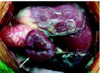 Fig. 2 - Left atrial appendage (arrow) juxtaposed to the right above the right atrial appendage