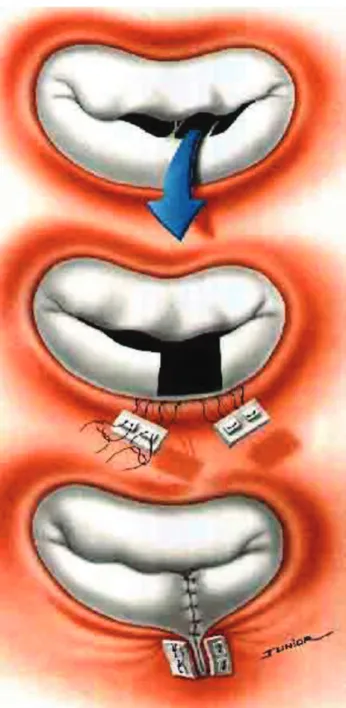 Fig. 1 - The ‘double-Teflon technique